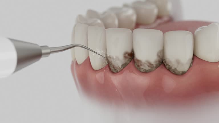 Trusted Wisdom Tooth Removal service in Madison, IN - Dentist Open Now